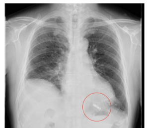 pacemaker